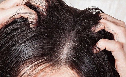 Thông tin về cách trị nấm da đầu sạch và giúp bạn đầy tự tin