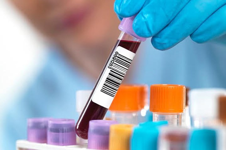 MCV là gì và ý nghĩa của chỉ số trong xét nghiệm máu