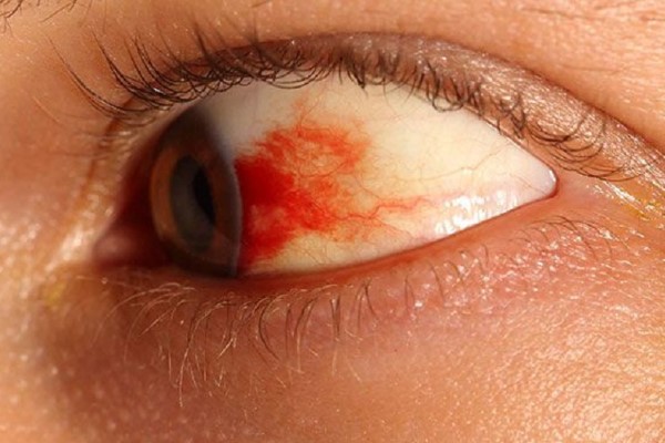 Nguyên nhân gây máu bầm trong mắt