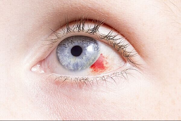 Máu bầm trong mắt có nguy hiểm không?