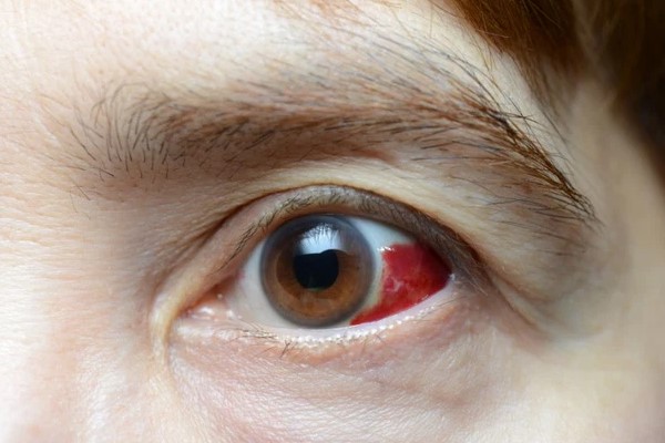 Hiện tượng máu bầm trong mắt có nguy hiểm không?