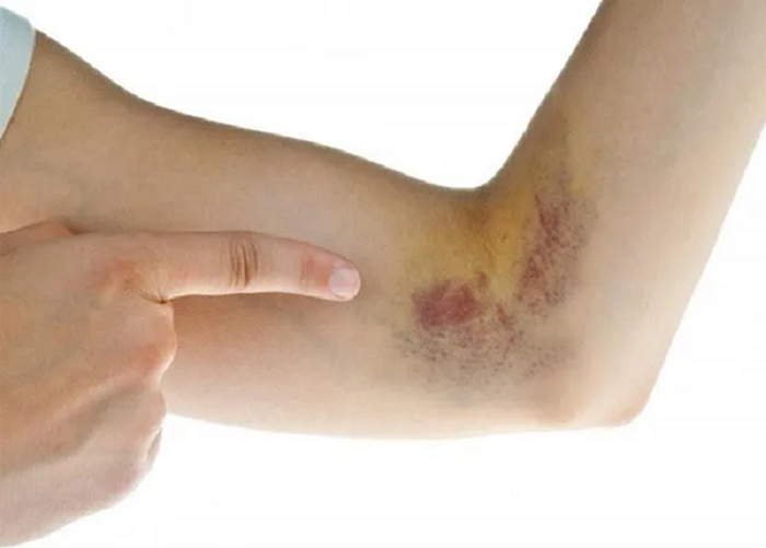 dau-hieu-ung-thu-mau-1