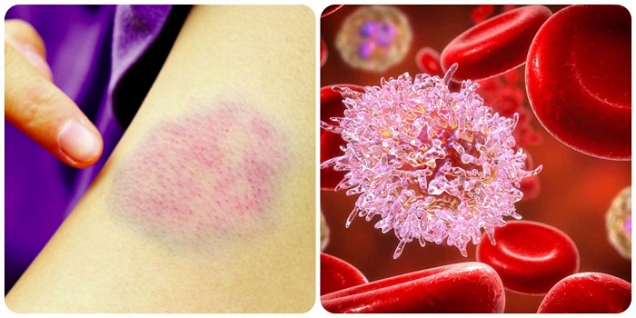 dau-hieu-ung-thu-mau